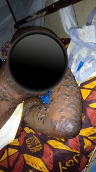 RCA/ Épidémie de Monkeypox à Bangui, Le Ministère de la Santé et de la Population alerte 