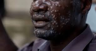 Une nouvelle souche de Mpox, se propage très rapidement en Afrique, déjà 38 465  cas et 1 456 décès 